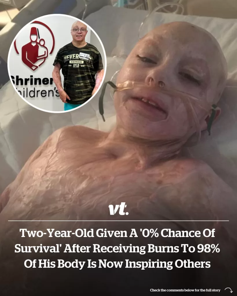 TWO-YEAR-OLD GIVEN A ‘0% CHANCE OF SURVIVAL’ AFTER RECEIVING BURNS TO 98% OF HIS BODY IS NOW INSPIRING OTHERS