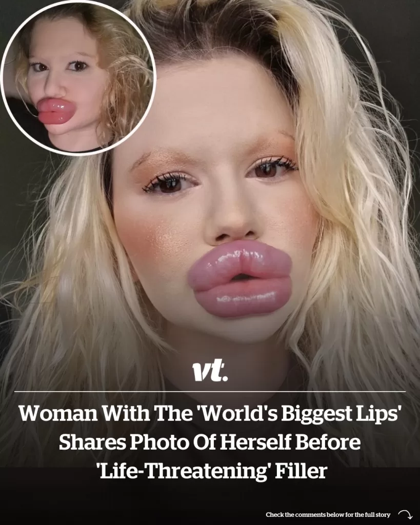 Woman with the ‘world’s biggest lips’ shares photo of herself before life-threatening filler