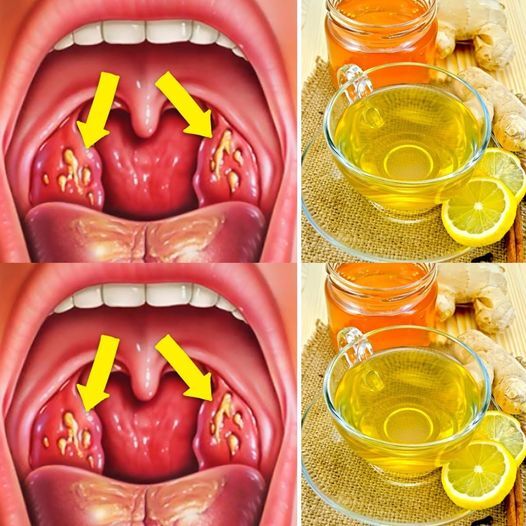 Natural Remedies for Tonsillitis: Alleviate Throat Pain and Find Relief