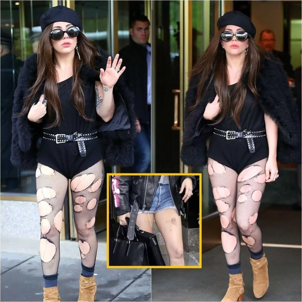 Lady Gaga displaying giant bruises on her thighs in ripped fishnet pants in New York