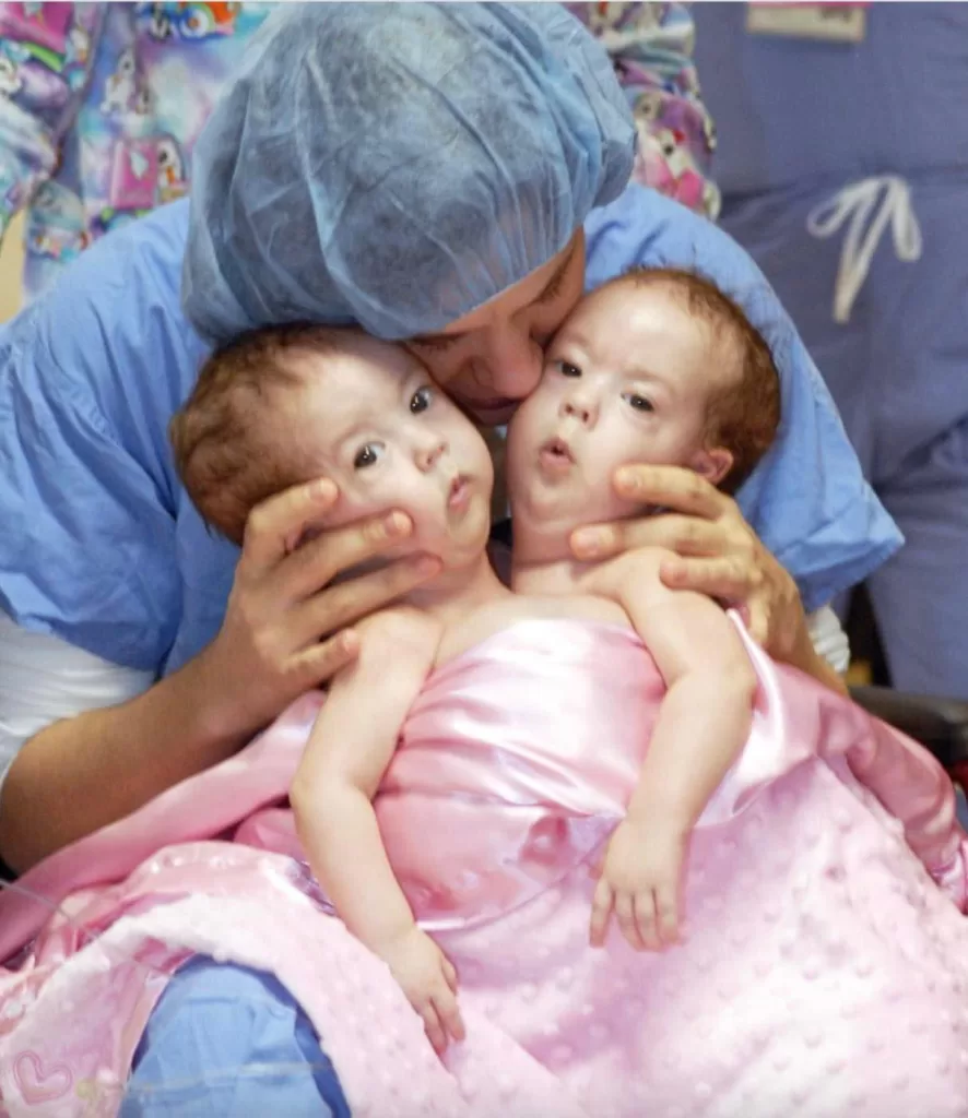 Conjoined Twins Bella And Abby Were Genuinely Associated From Birth, Yet Medical Procedure Changed Everything