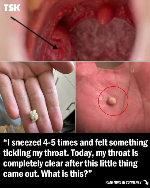 Everything You Need to Know About Tonsil Stones